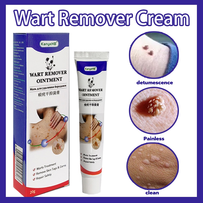 Warts Remover Original Warts Remover Warts Remover Cream Genital Warts Remover Plantar Warts 7907