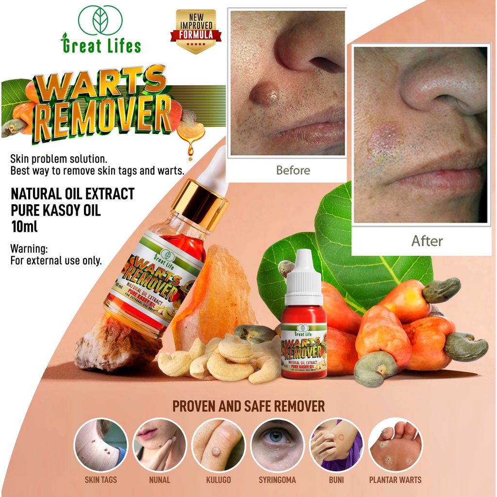 Original Warts Remover Skin Problem Solution 100 Pure Kasoy Oil Natural Extract 10ml Shopee