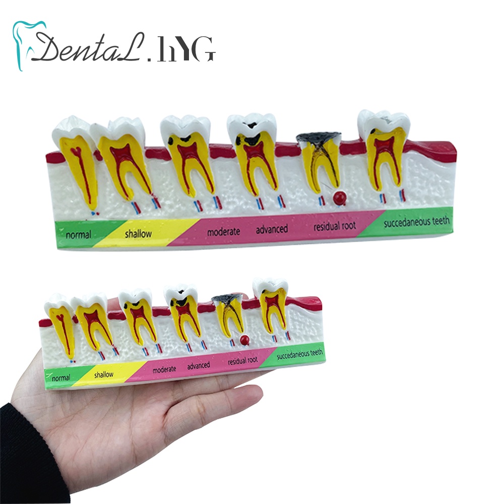 Dental Caries Classify Tooth Model of Pathological Process Around Teeth