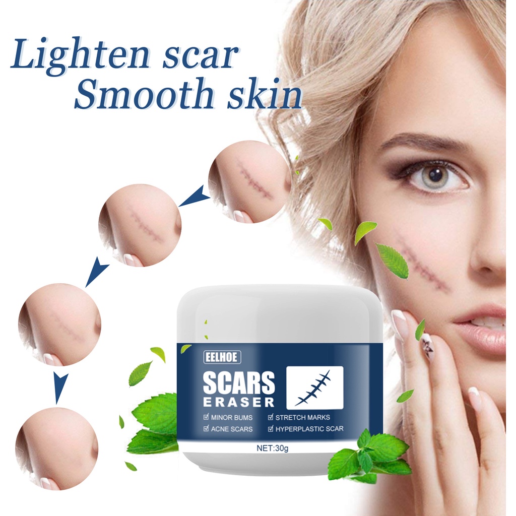 Scar Remover Cream Strech Mark Remover Pimple for old and new Scar