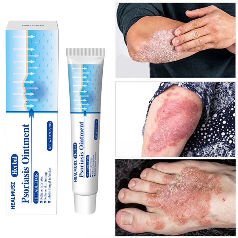 bioderm ointment ♗Antibacterial Psoriasis Cream Itch Eczema Relief Skin Rash Urticaria Treatment