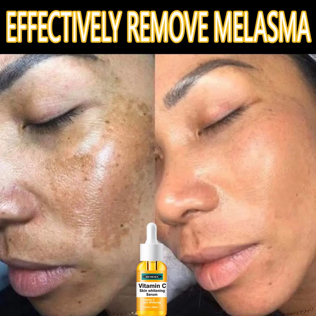 Hemeiel Vitamin C Serum/Melasma Soap/Vitamin E Serum For Face/Dark