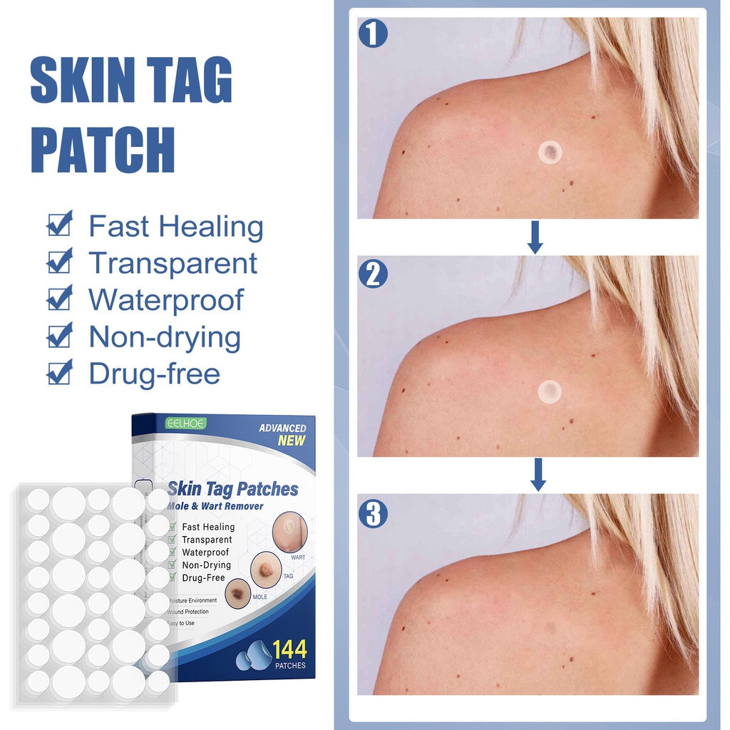 Kelou patch skin label remover patch Kelou flesh nevus black nevus ...