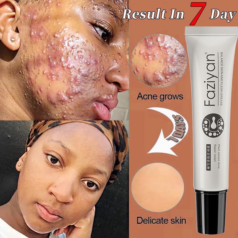 Pimple Marks Remover Cream Anti Acne Effective Acne Scar Remover Cream