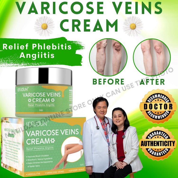 SEFUDUN Varicose Vein Cream Remover Pain Reliever For Legs Spider Veins ...