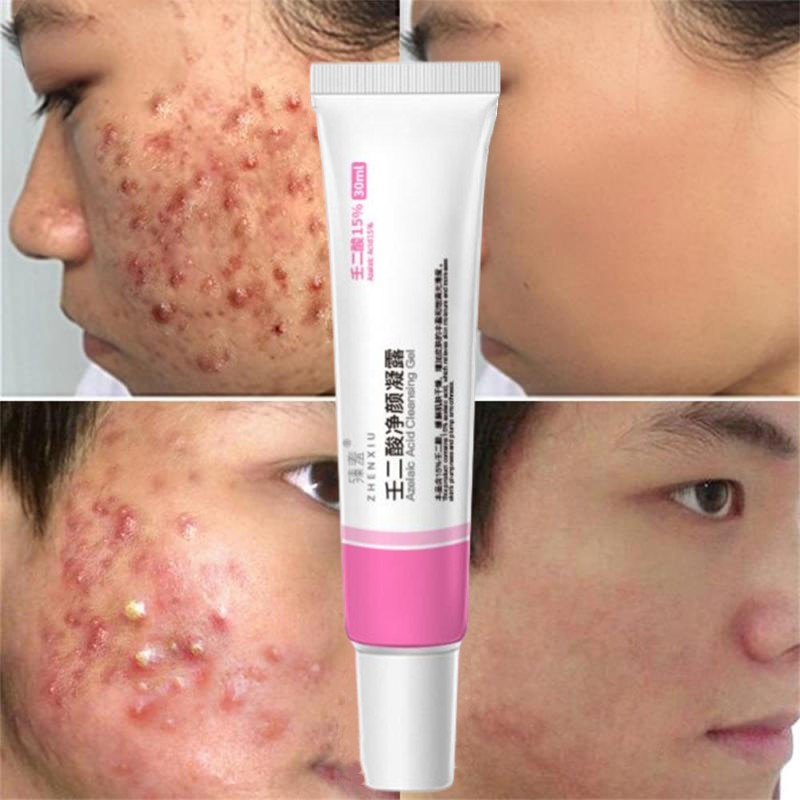 2PCS 15 Azelaic Acid Gel Acne Blackhead Removal Shrink Pores Salicylic