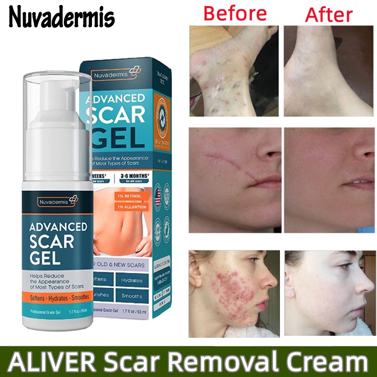 Nuvadermis Advanced Scar Removing Gel, Surgical Scar Acne Print Old