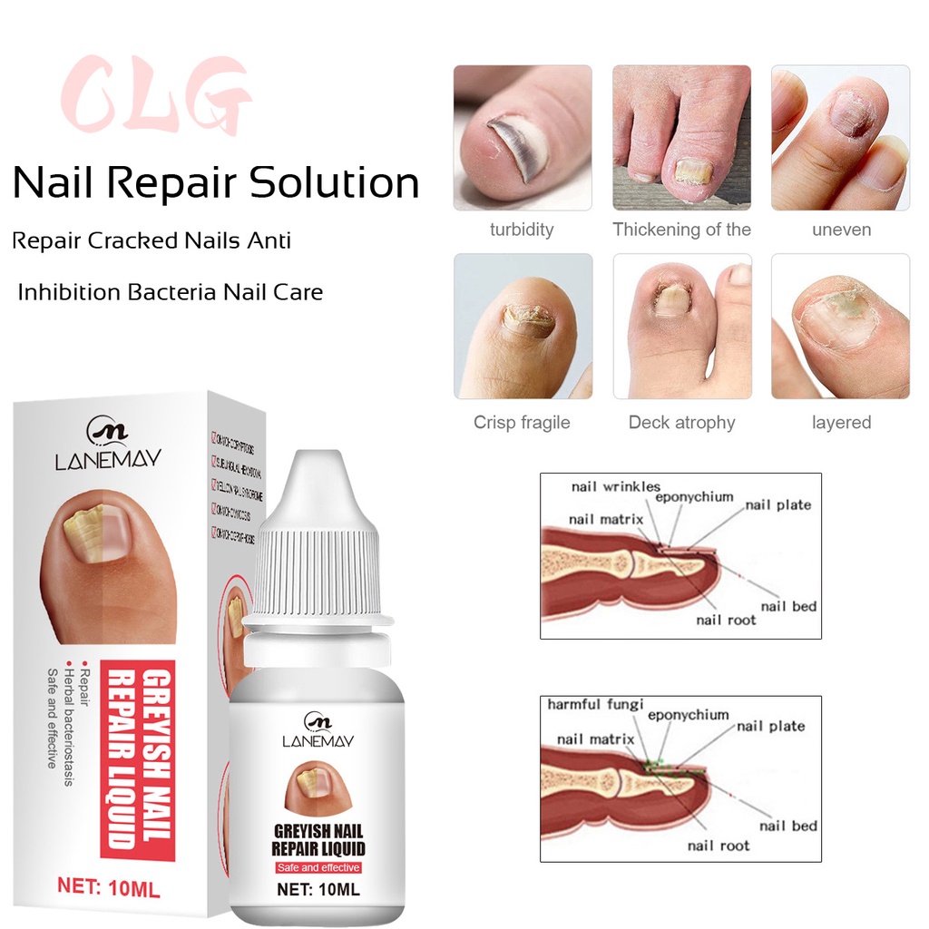 CLG Nail Care Liquid Effective Treatment Nail Repair Cracked Nails Anti