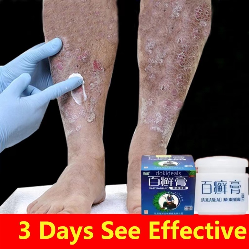 Original Psoriasis Eczema Cream for Psoriasis Eczema Rosacea Acne