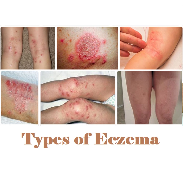 ┇Eczema Solution Psoriasis Solution Dermatitis alergies Rashes Solution ...