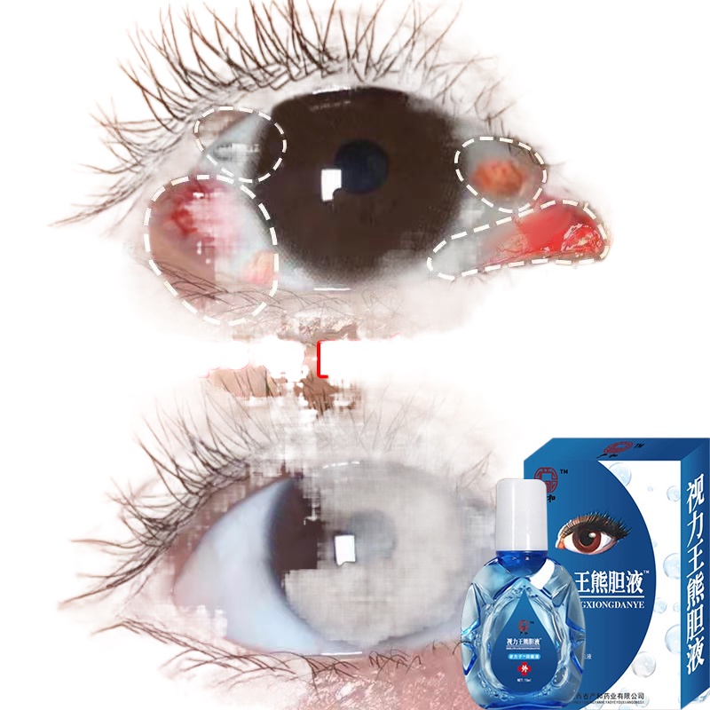 100 effective Eye drops original Eyedrops eye drops for clear vision