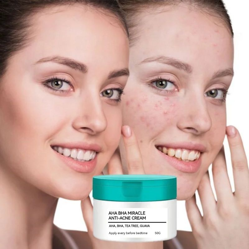 AHA BHA MIRACLE CREAM/ ANTI ACNE CREA/ QUICK EFFECT ACNE SPOT CORRECTOR ...