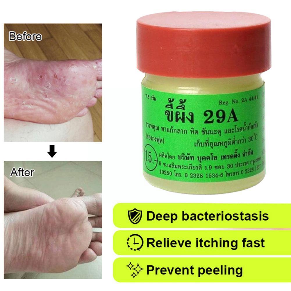 25UY Anti Fungal Treatment Ringworm Scabies Athletes Foot Tinea