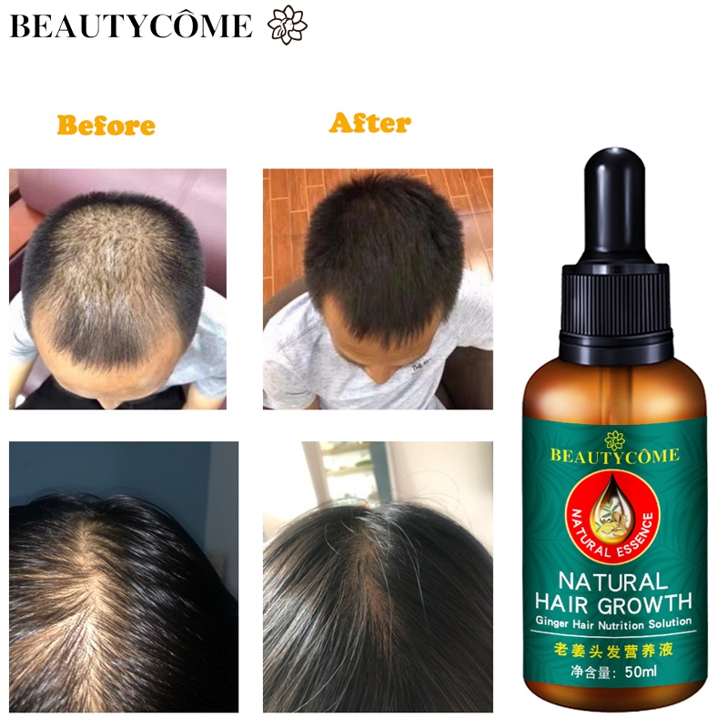 ¤ YOUNGCOME Hair Growth Essence Anti Hair Loss Liquid Fast Hair Grower ...