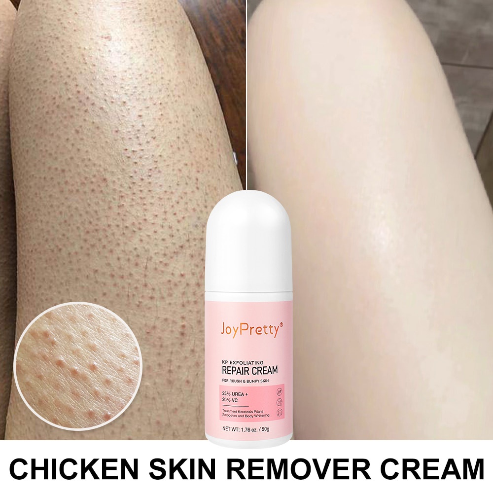 Body Cream Chicken Skin Removal Treatment Keratosis Pilaris Lotion