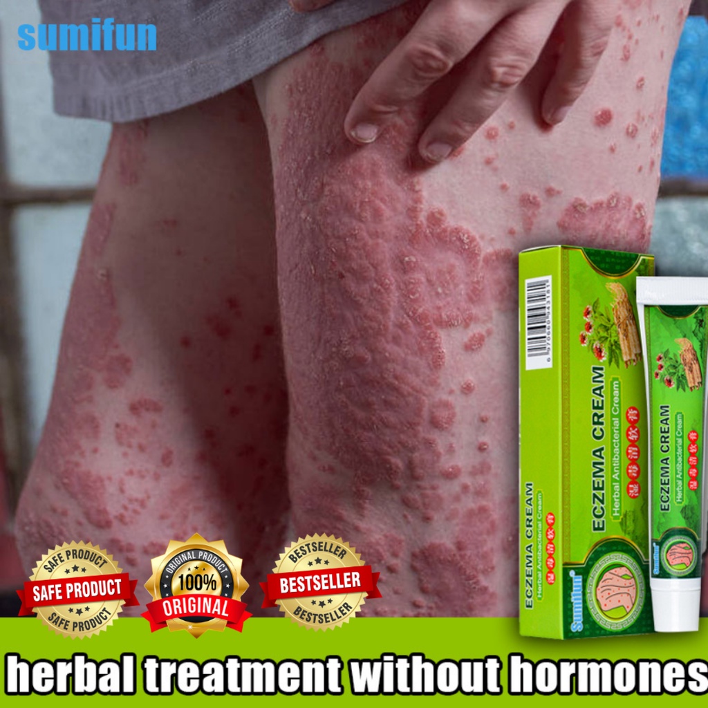 100 Effective Sumifun Eczema Treatment Cream Original Eczema Psoriasis