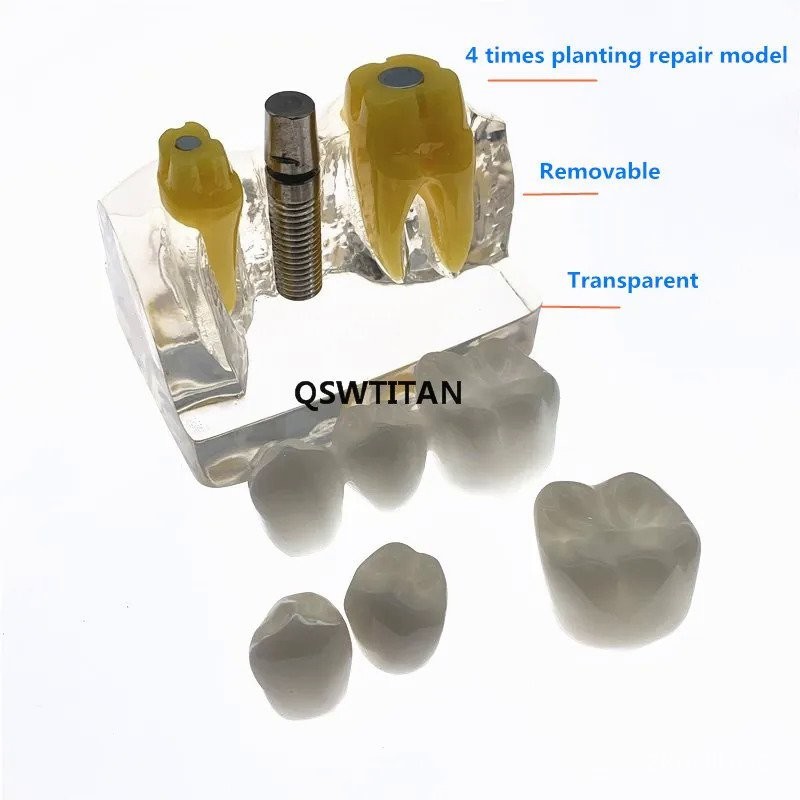 Dental 4 times planting Teeth model Analysis Crown Bridge Removable ...