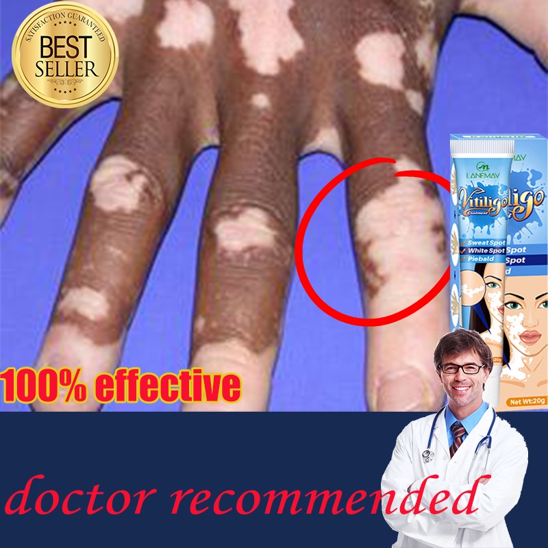 vitiligo treatment cream vitiligo remover vitiligo cream 20g Vitiligo Skin Treatment Vitiligo