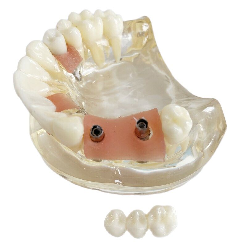 Dental Teaching Model Implant Molar Maryland Bridge Maxillary ITI
