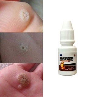 10ml Foot Toes Corn Callus Removal, Corn Callus Patch, Corn Cream