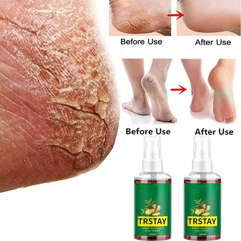 Bacterial and Fungal Inhibition Essential Oils Foot Cream Chapped Feet