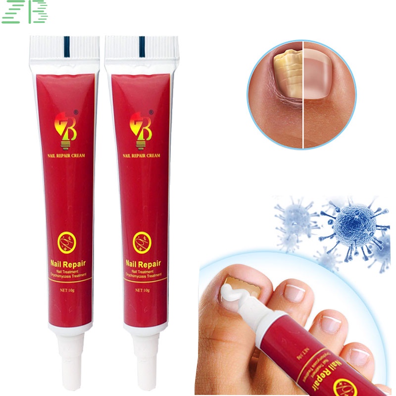 anti-itch-ointment-1pcs-nail-fungus-removal-cream-onychomycosis-fungal