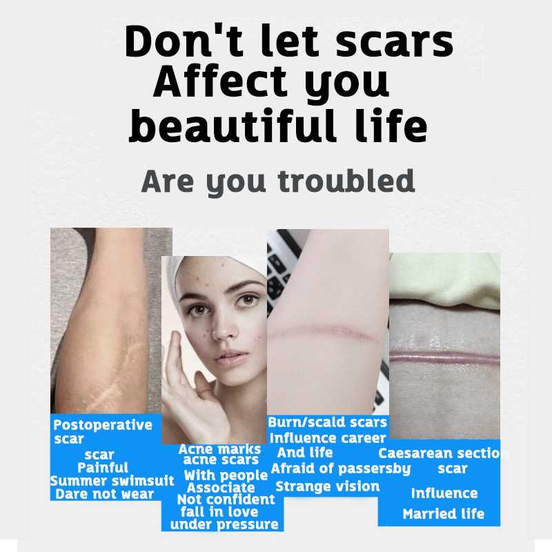 Scar Remover Gel Cream Stretch Marks Removal Ointment Acne Scar Pimples
