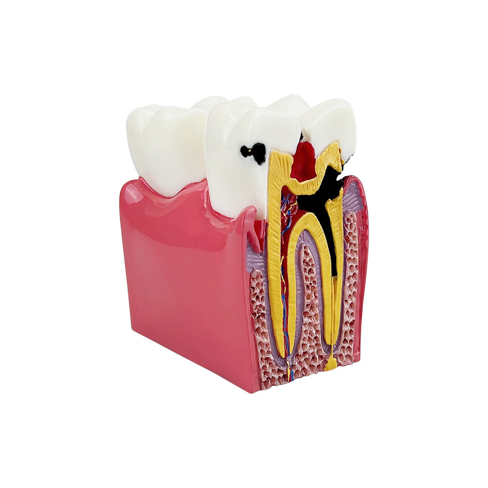 Dental Study Teaching Model 6 Times Dental Caries Comparsion Models ...
