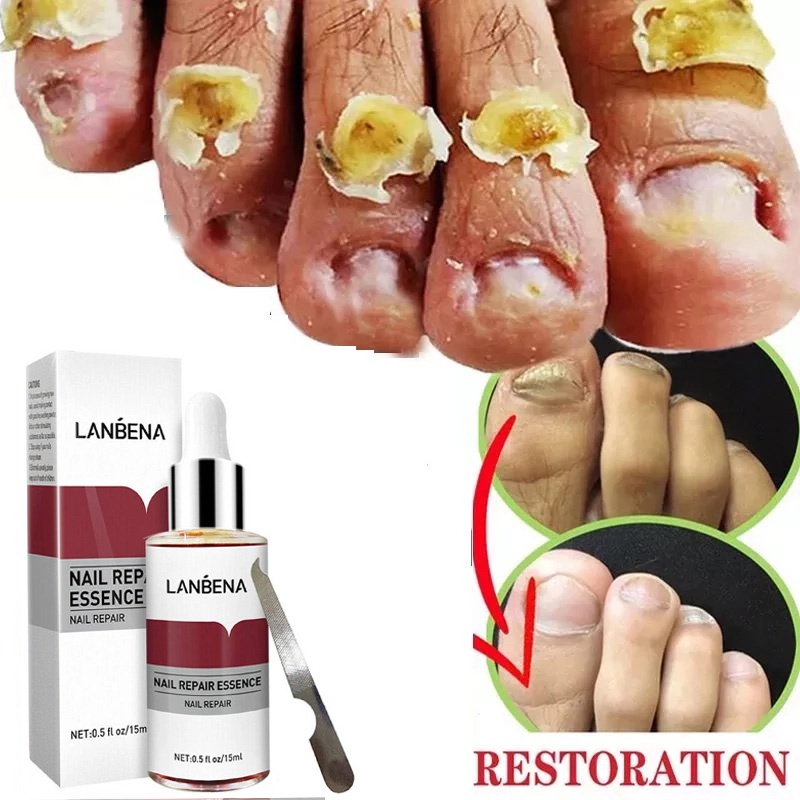 ﹍LANBENA Nail Repair Essence Serum Fungal Nail Treatment Remove