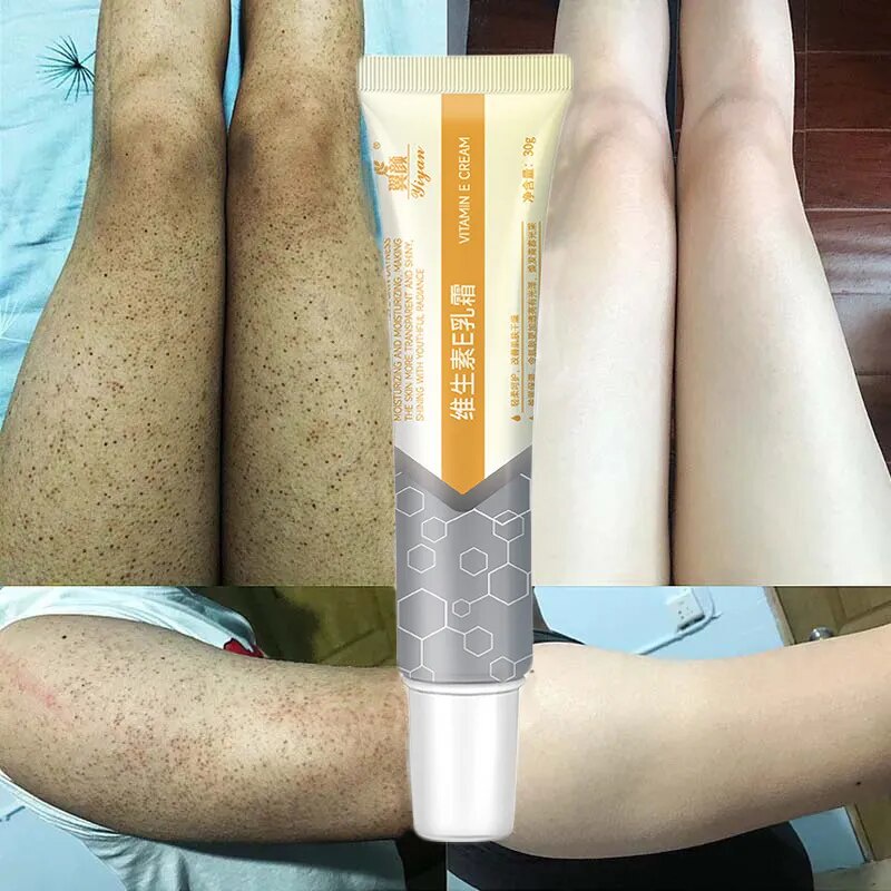 Body Whitening Cream Treatment Keratosis Pilaris Vitamin E Removal