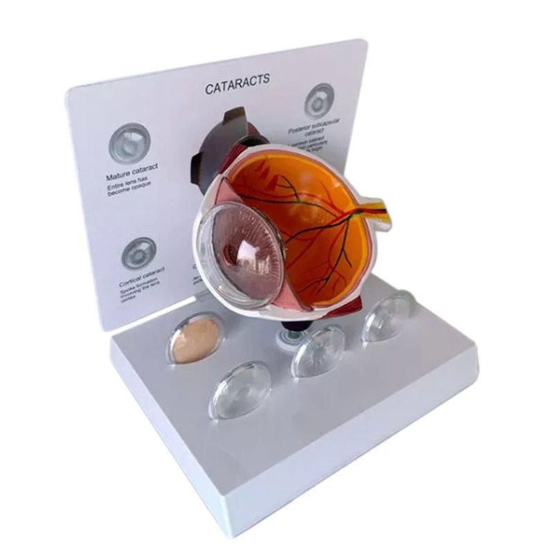 educational advance enlarged human cataract eye model for sale with eye ...