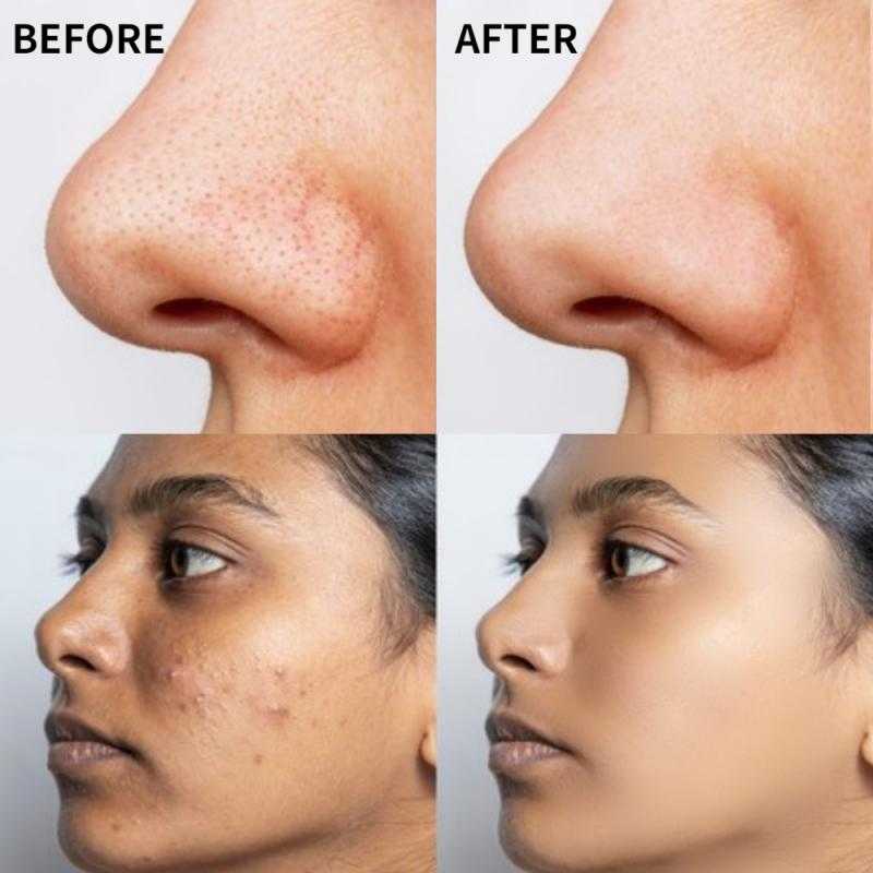 The Ordinary Salicylic Acid 2 Solution Acne / Blemishes / Clogged