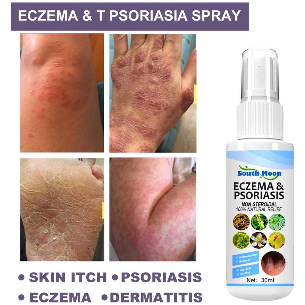 Eczema and psoriasis treatment spray for skin diseases antifungal, anti