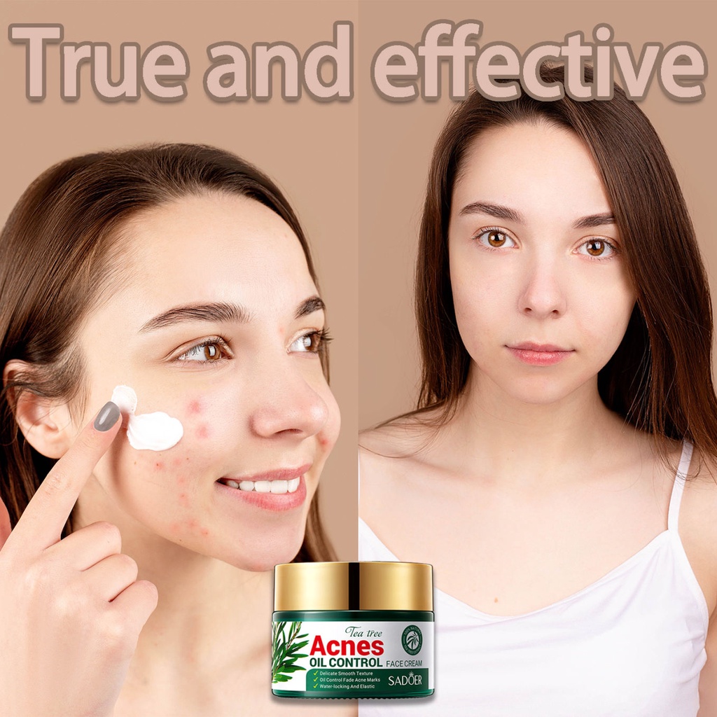 Salicylic Acid Acne Remove Acid Acne Cream 50g Anti Acne Scar Pimple