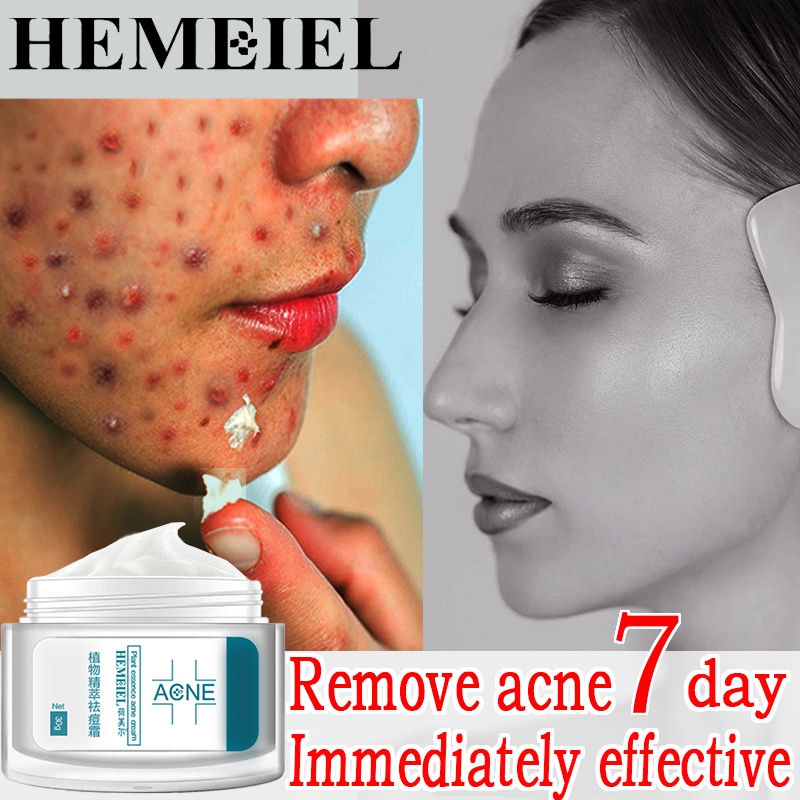 HEMEIEL Anti Acne And Pimples/Gamot Sa Pimples Cream/Pampatanggal Ng