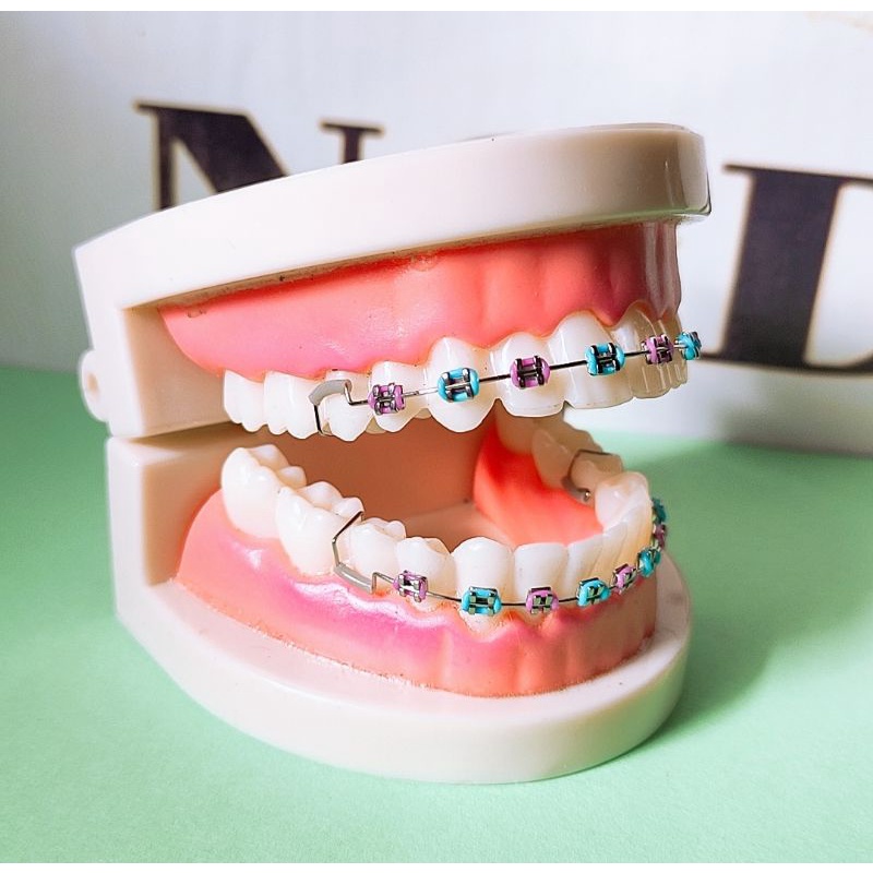 玲Retainer Braces Color Combination Design Shopee Philippines