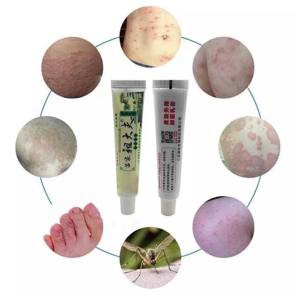 ORIGINAL Zudaifu Cream Miracle Cream Ointment for Allergy Itchy Skin Eczema Psoriasis Treatment