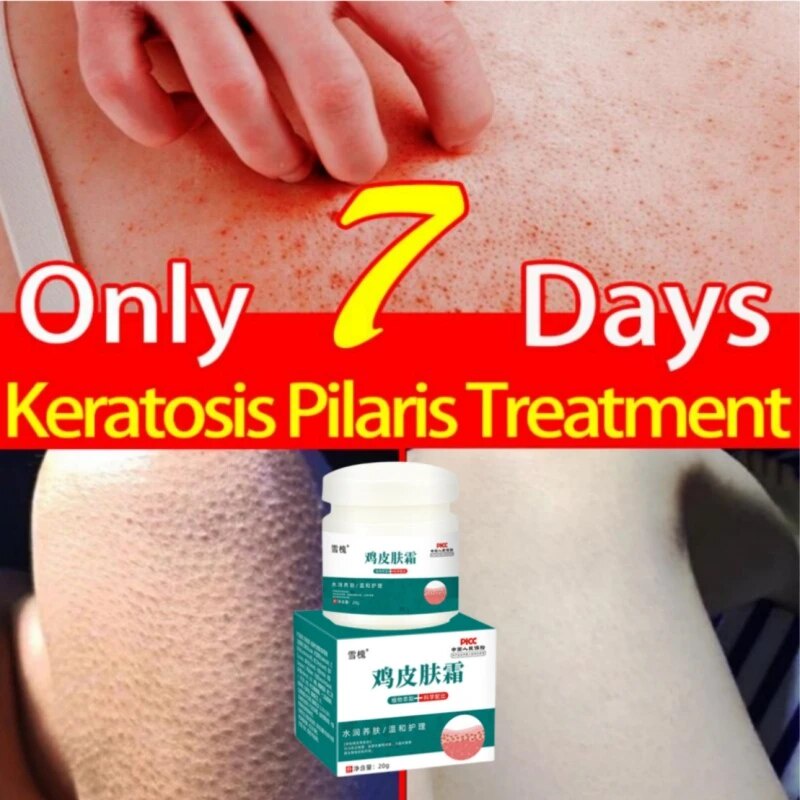 ☑Curing Keratosis Pilaris/ Kp/ Chicken Skin Body Lotion Repair Dry
