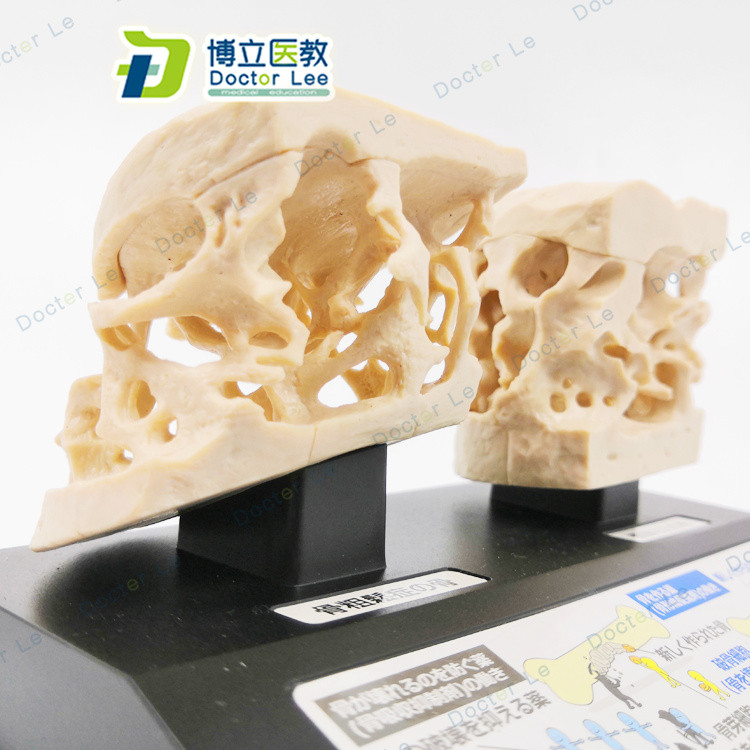 Human Spinal Femoral Osteoporosis Demonstration Model -유 4MZ | Shopee ...