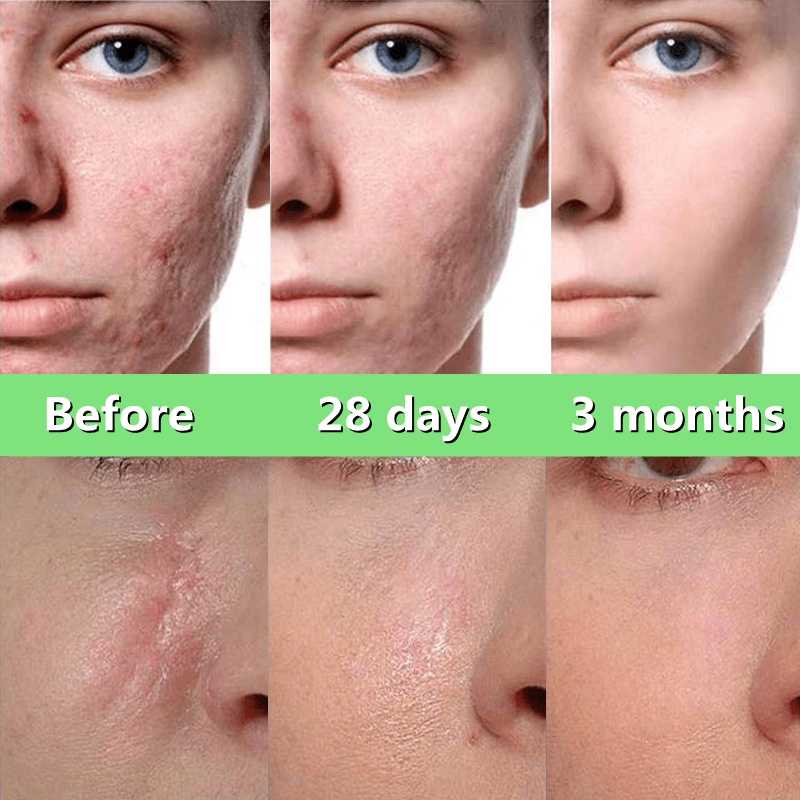 100 Authentic ALIVER Scar Remover for Old Scar on Leg Stretch Mark Gel