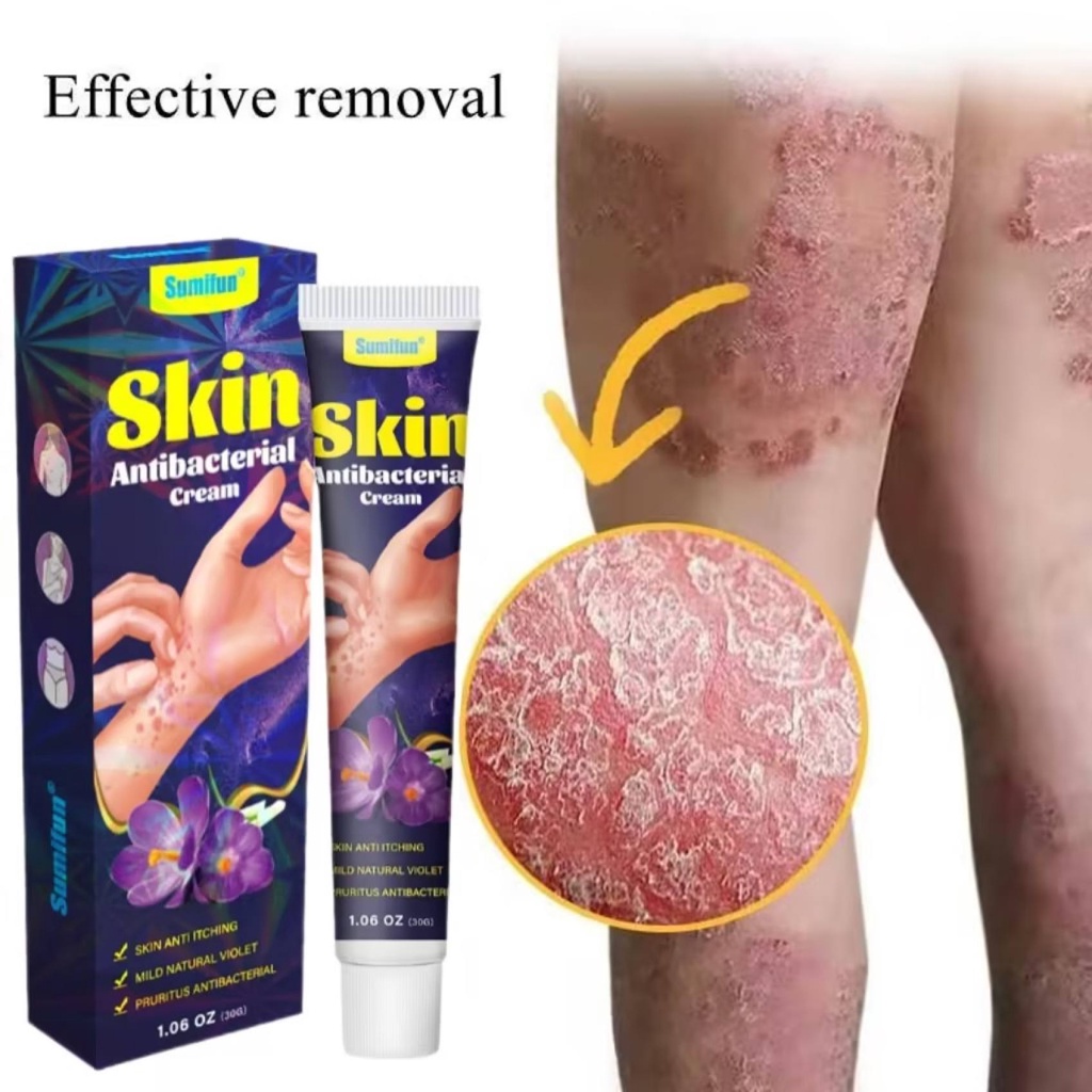 3 Seconds Relieve Itching Sweat Herpes Treatment dermatitis eczema ...