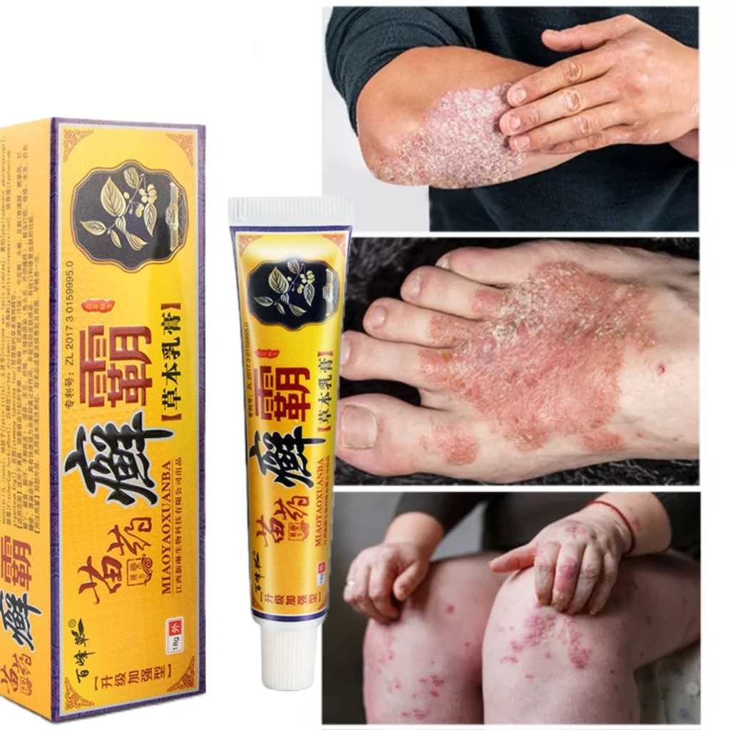 Sumifun Eczema Treatment Cream Atoderma Cream Original Gamot balat