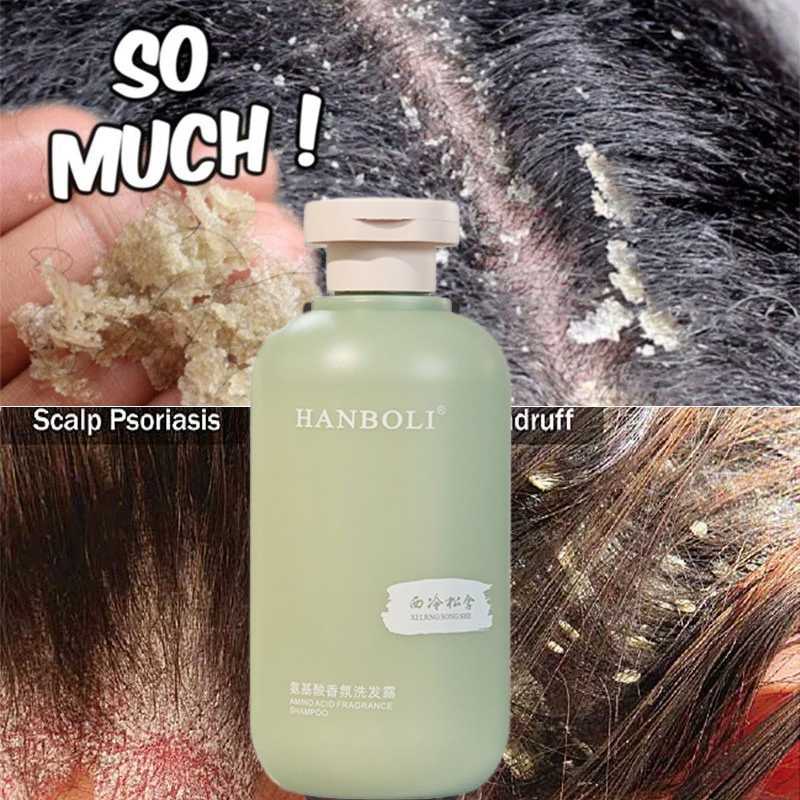 Anti Dandruff shampoo, Dandruff Remover, Anti Fungal, Anti Itchy Japan
