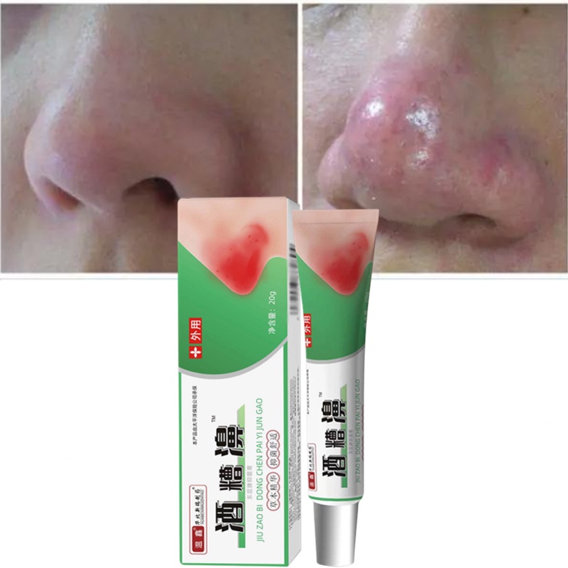 Hemorrhoids cream Rosacea Cream Red Nose Ointment Remove Blackhead Acne