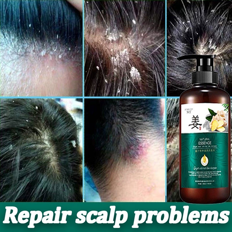 shampoo Antidandruff shampoo Ginger antidandruff shampoo Remove dirt
