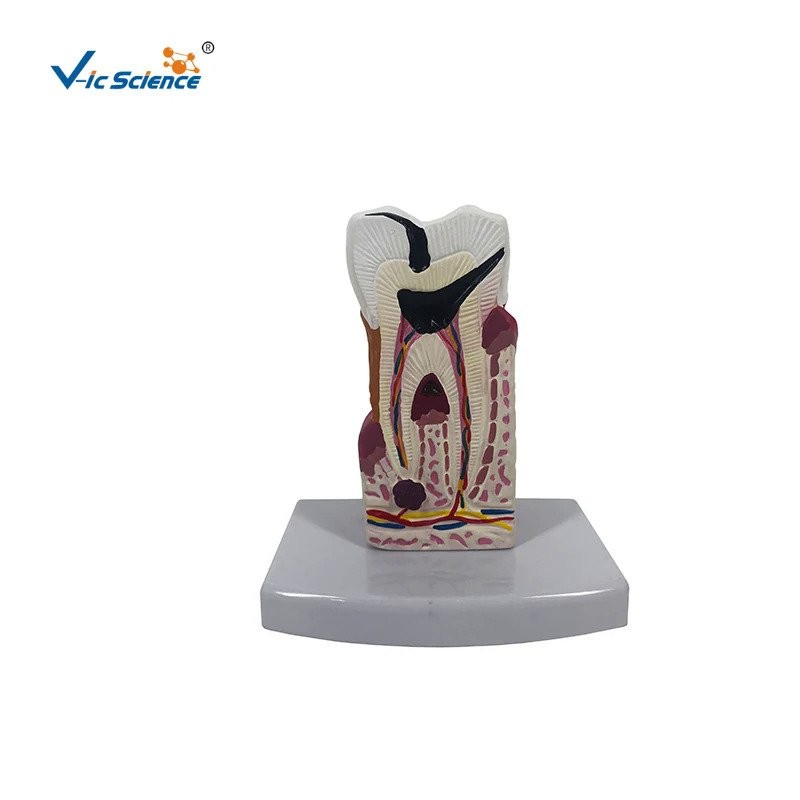 teeth practice tooth model dental caries model 10 times life size ...