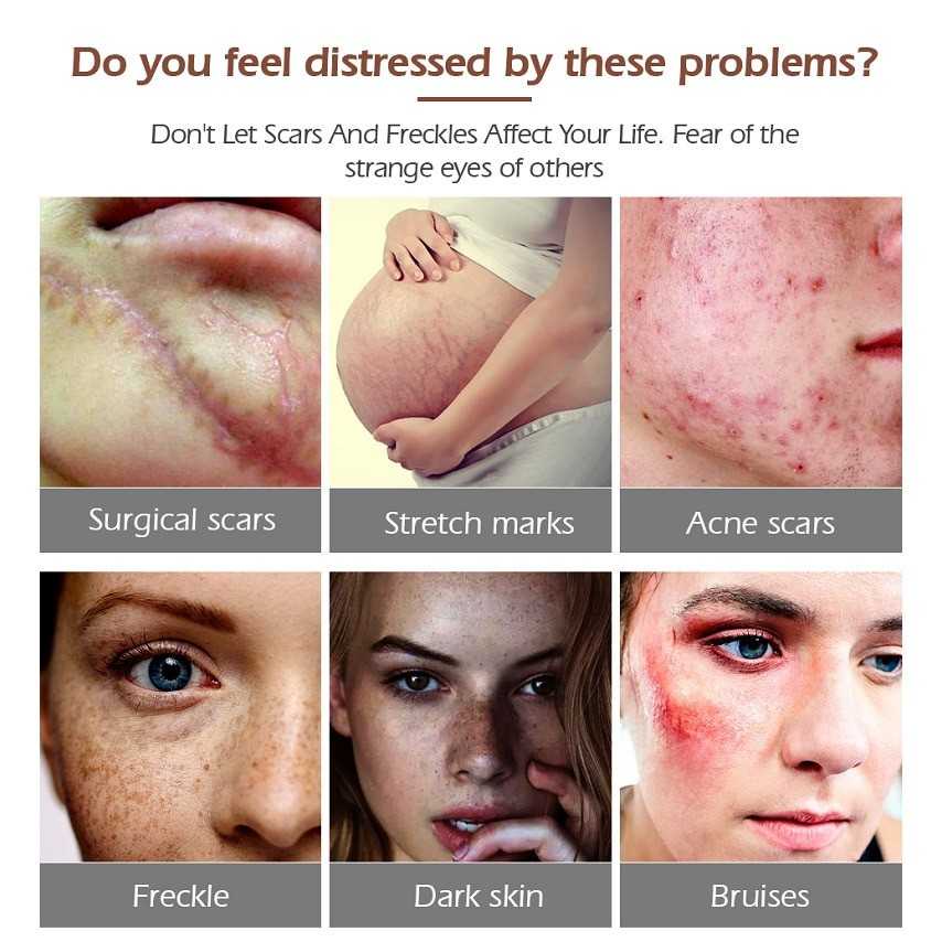 Aliver Scar Removal Cream 30g Remove Old And New Scars Peklat Stretch