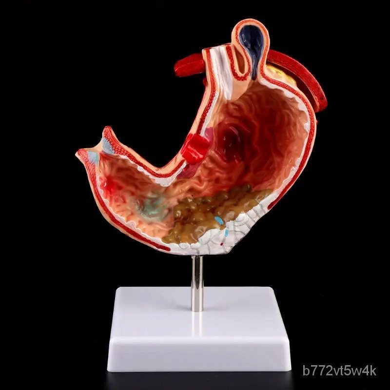 Human Anatomical Anatomy Stomach Medical Model Gastric Pathology ...