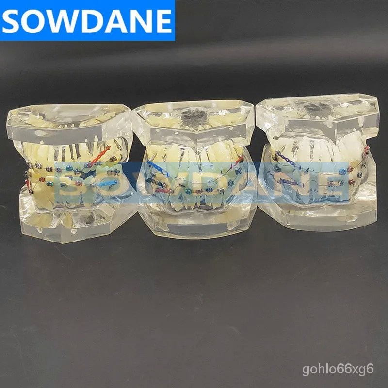 Transparent Dental Orthodontic Mallocclusion Model with Brackets ...