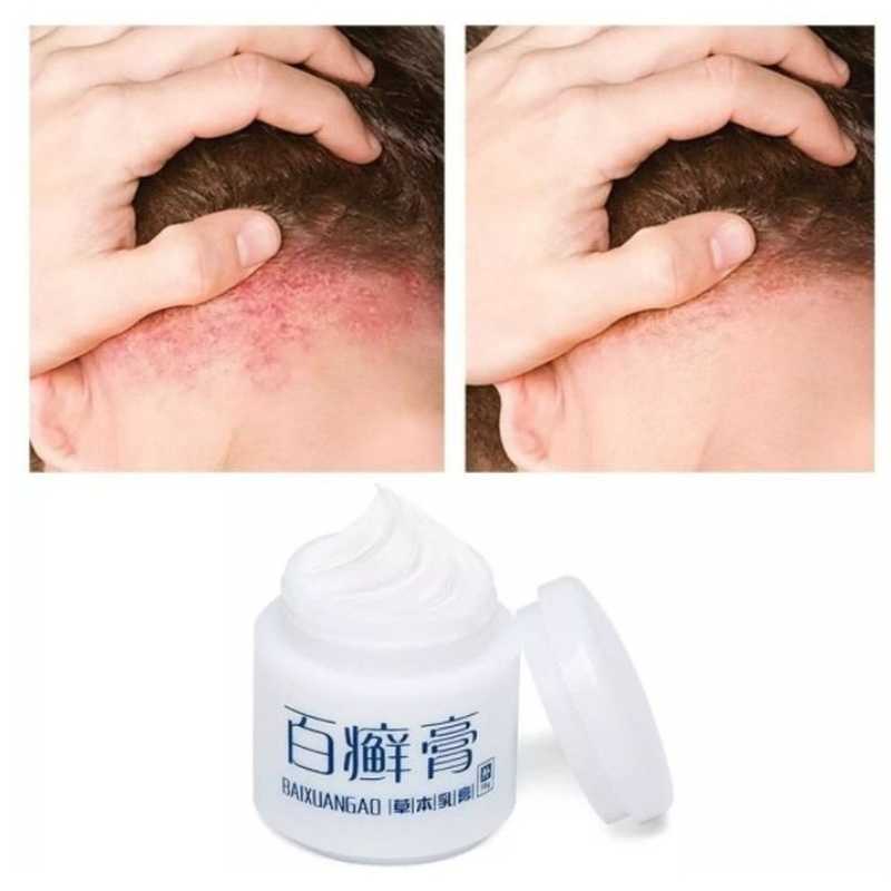 Herbal Hundred Ringworm Cream Miracle Cream Psoriasis Eczema Rosacea